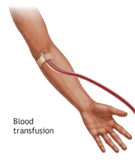 blood transfusion